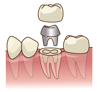 を 歯 寿命 抜い た 神経 ・１本の歯は約６回の治療で抜歯に。歯の寿命を変えるために一つひとつの治療から