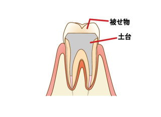奥歯の差し歯の治療方法とは 差し歯 かぶせ物の種類と特徴を比較 四元歯科 鹿児島市