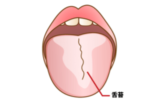 口臭の原因は 舌苔 舌べろを傷つけない磨き方のポイント 四元歯科 鹿児島市