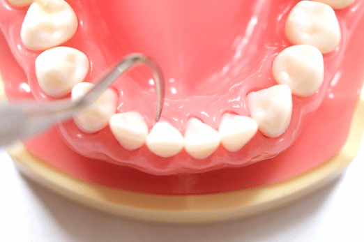 歯石取りを自分でする際の注意点 安全なセルフケア方法とは 四元歯科 鹿児島市